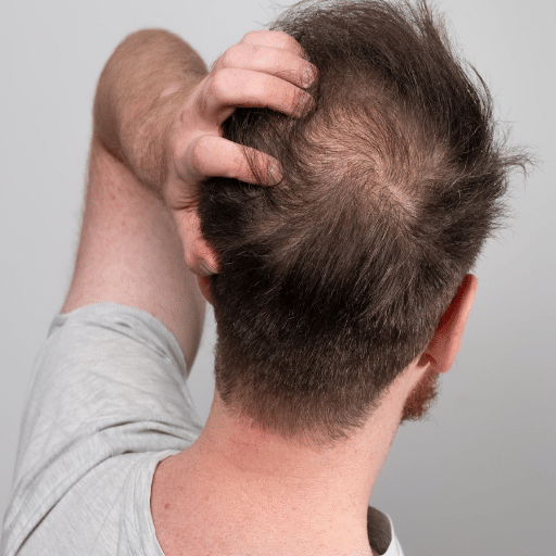 Understanding Hair Loss and Its Impact