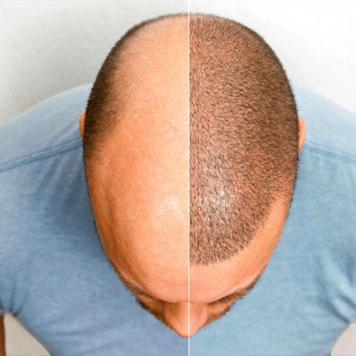 understanding hair transplants