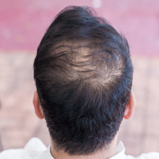 understanding thin hair in older men