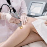 Best Deodorants to Use After Laser Hair Removal