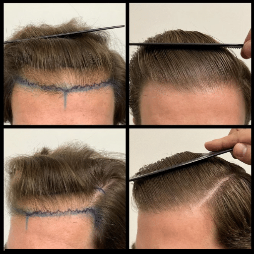 Hair Transplant Options