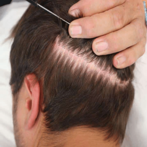 Hair Growth Timeline After Transplant