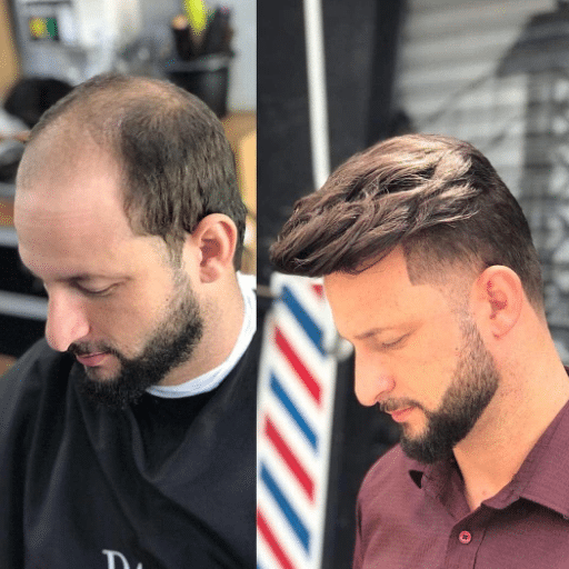 Hair Replacement and Hair Systems