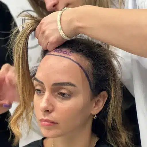 Long Hair After Transplant: A Comprehensive Guide to Growth and Care hair care post transplant