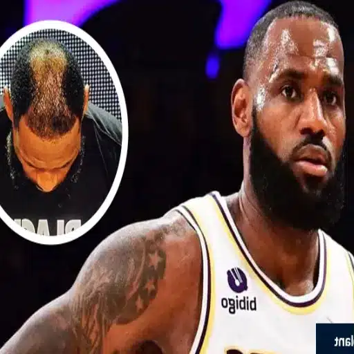 Exploring the Challenges Faced by LeBron James Before Hair Transplant Decisions lebron james