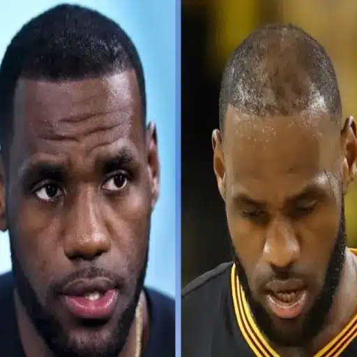Exploring the Challenges Faced by LeBron James Before Hair Transplant Decisions lebron james and his hair transplant experience