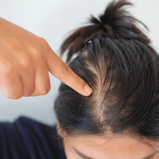 Long-Term Strategies for Hair Regrowth