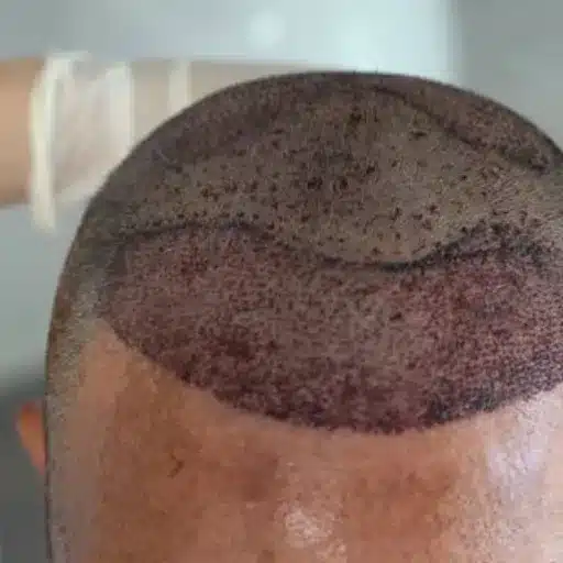 The Truth Behind Hugh Laurie Hair Transplant: A Closer Look at His Hair Transformation the science behind hair restoration