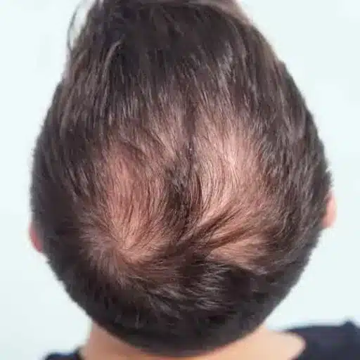 understanding hair loss and its impact