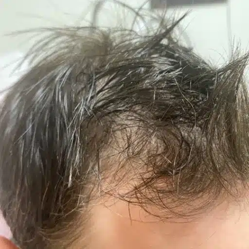 The Truth Behind Hugh Laurie Hair Transplant: A Closer Look at His Hair Transformation understanding hair loss and its impact
