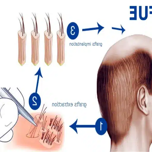 understanding hair transplantation techniques