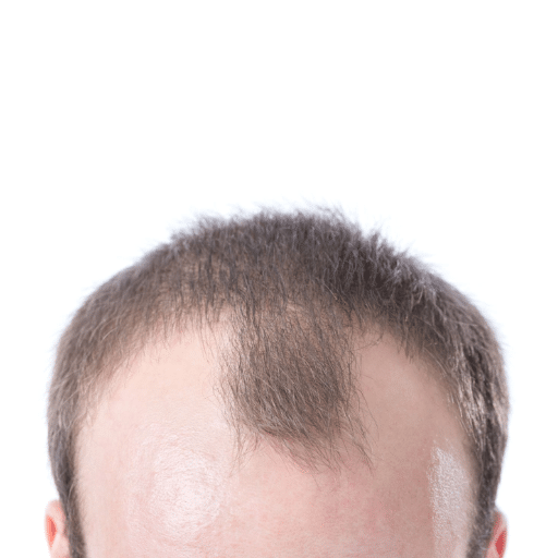 understanding thinning hair and receding hairlines