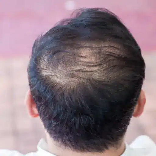 Stylish Solutions for Older Men’s Hairstyles That Suit Thinning Hair Perfectly understanding thinning hair in older men