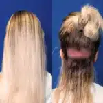long hair after transplant