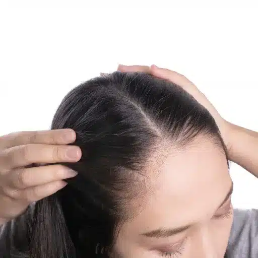 Hairstyles for Women: Embracing Hair Thinning at Temples hairstyles for women embracing hair thinning at temples